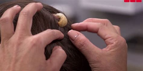 Woman Seeks Dr Pimple Poppers Help Removing Horn On Head Fox News