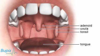 tonsils and adenoids pictures Holistic Wellness, Health And Wellness Картинка - tonsils and adenoids pictures Holistic Wellness, Health And Wellness