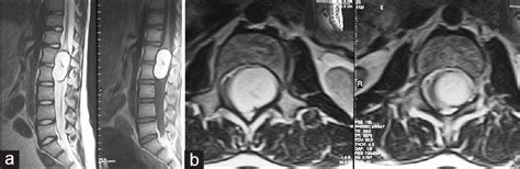 Intramedullary Mature Teratoma Of The Conus Medullaris Journal Of Neurosciences In Rural Practice