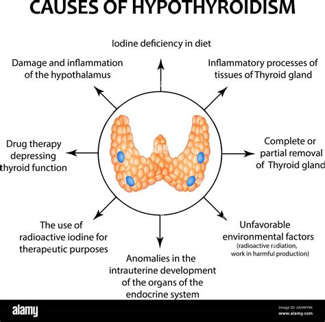 The Causes Of Thyroid Hypothyroidism Infographics Vector Illustration