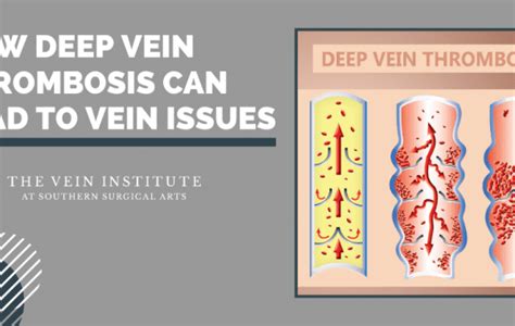 Vein Treatment In Chattanooga The Vein Institute At Ssa