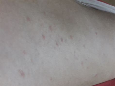 I Am So Confused Rn Please Help Pityriasis Rosea Forums Patient