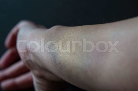 Bruised Arm Stock Bild Colourbox