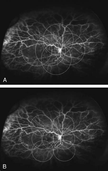 Ultra Wide Field Angiography With Standard Montage Views Overlayed A