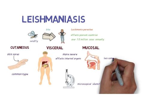 Leishmaniasis Treatment