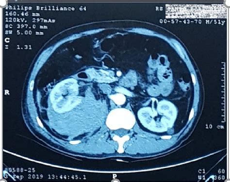 Contrast Enhanced Abdominal Ct Showed A Large Right Perirenal Hematoma