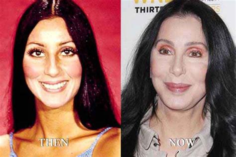 Cher Plastic Surgery 1 Cher Plastic Surgery Celebrities Then And Now