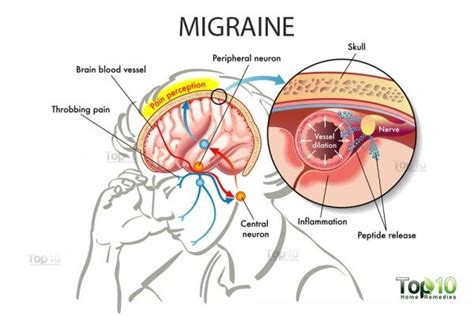 Migraines Home Remedies And Tips For Relief Top 10 Home Remedies