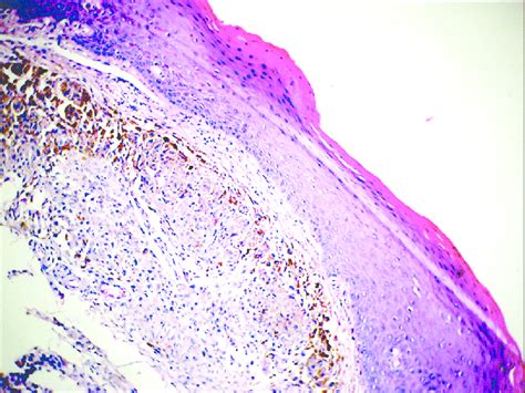 Hande Stained Section Showing Proliferation Of Nevus Cells In Mieschers