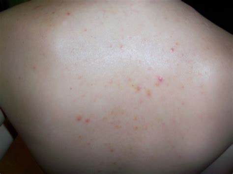 Red Bumps On Back Pimples On Back Of Head Under Hair