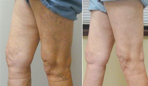 Before And After Photos Vein Specialists Of The Carolinas