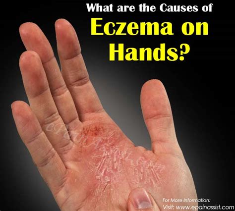 Causes Of Eczema On Hands And Its Treatment What To Do And What Not To Do