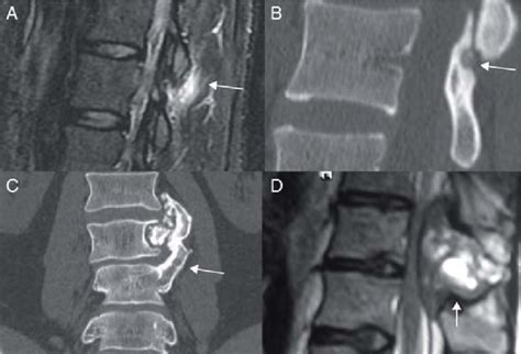 Osteoid Osteoma A Stir Mri Shows Hyperintense Edema Arrow B