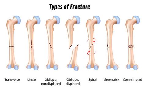 Fractures Diagnosis And Treatment Home Physio Group