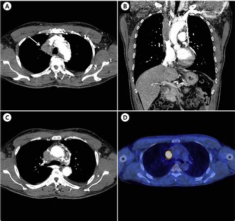 Figure 1 From Lung Cancer With Superior Vena Cava Syndrome Diagnosed By