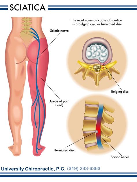 Sciatica Can Be A Severely Painful Condition That Extends From Your