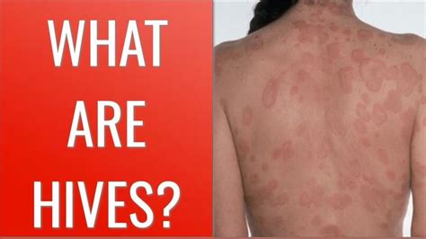 34 Best What Do Hives Look Like Images On Pinterest Cure