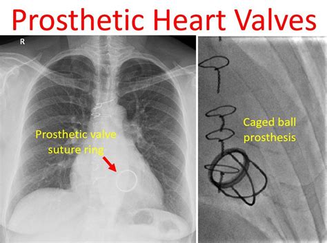 Prosthetic Heart Valves All About Cardiovascular System And Disorders