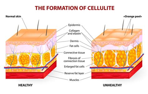 What Is Cellulite Really