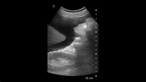 Ascites Ultrasound Image Interpretation Youtube