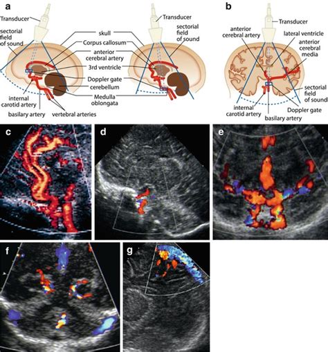 Neurosonography In Neonates Infants And Children Radiology Key