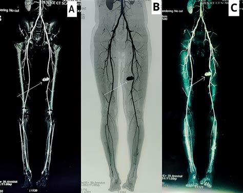 Cureus Successful Surgical Management Of Post Traumatic Superficial