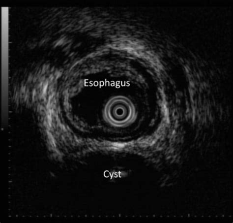 Endoscopic Ultrasonography Showed A Normal Esophageal Wall And A Cystic