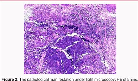 Figure 2 From A Rare Case Of Mucosa Associated Lymphoid Tissue Malt