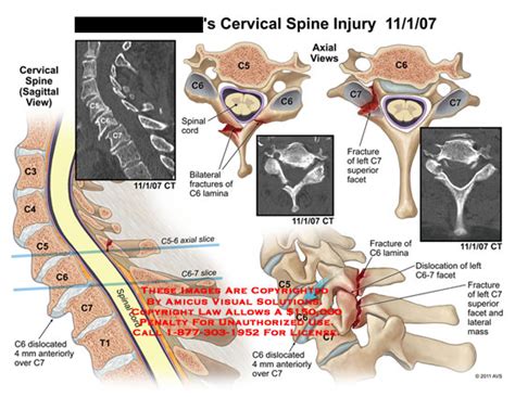 AMICUS Illustration Of Amicus Injury Cervical Spine Vertebrae CT C6