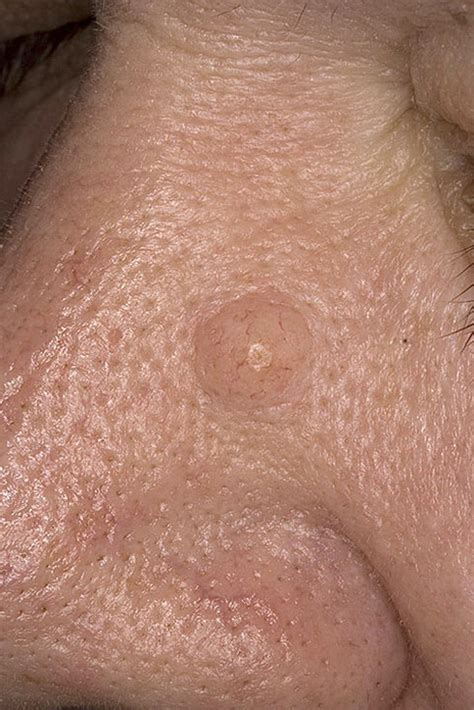 Basal Cell Carcinoma Nose Pictures 54 Photos And Images
