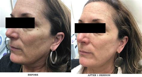 Bbl Before And After Photos Patient 9 Washington Dc Mi Skin Dermatology Center Melda Isaac Md