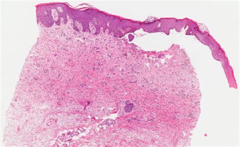 Subepidermal Blister With Eosinophils And Adjacent Psoriasiform