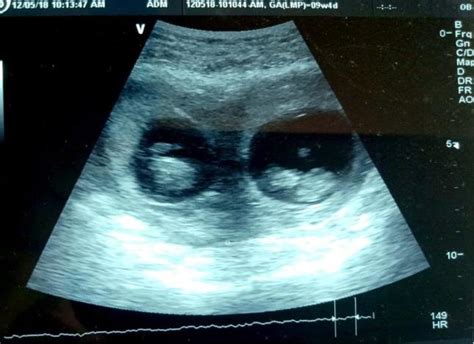 Ultrasound At 96 Weeks Showing Bicornuate Uterus With Twin Pregnancy