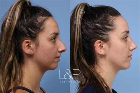 Rhinoplasty And Chin Implant For Gorgeous Bay Area Young Woman