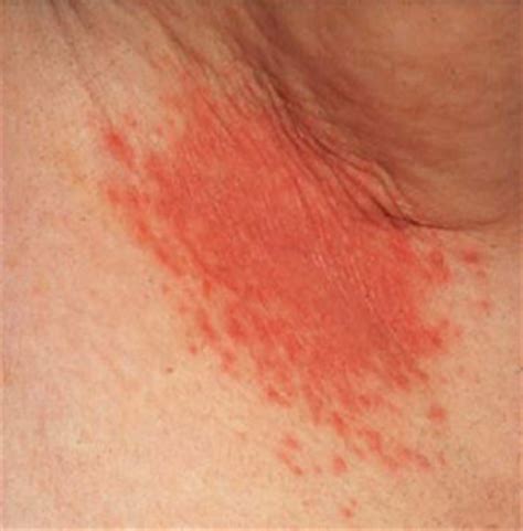 Intertrigo refers to a type of inflammatory rash of the superficial skin that occurs within a person's body folds.1 these areas are skin affected by intertrigo is more prone to infection than intact skin.1. Intertrigo - Ciencias Médicas