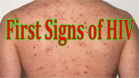 You Are Hiv Positive If You See This 11 Signs Must Read And Get