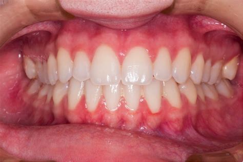 White Spots On Teeth Treatment Turnerdesignonline