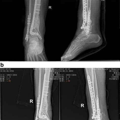 A 47 Years Old Male Patient With Segmental Defects Of The Right Tibia