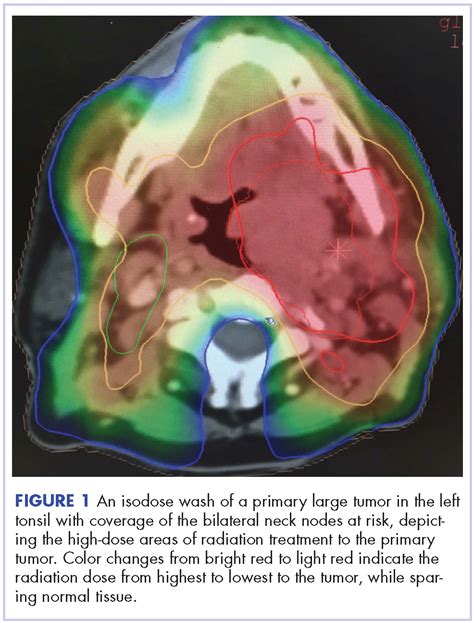 Management Of Tonsillar Carcinoma With Advanced Radiation Therapy And