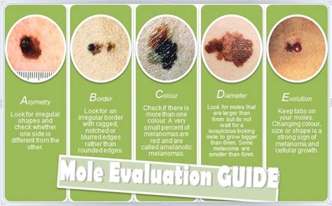Are Moles Dangerous Dermletter