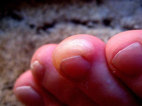 How Should Runners Deal With A Blister Under Their Toenail Runners Goal