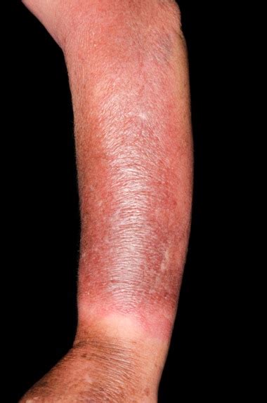 Nhs 111 Wales Health A Z Cellulitis