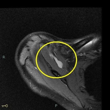 Intramuscular Ganglion Cyst Radiology Reference Article Radiopaedia Org