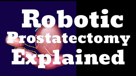 Robotic Prostatectomy Steps Explained Youtube