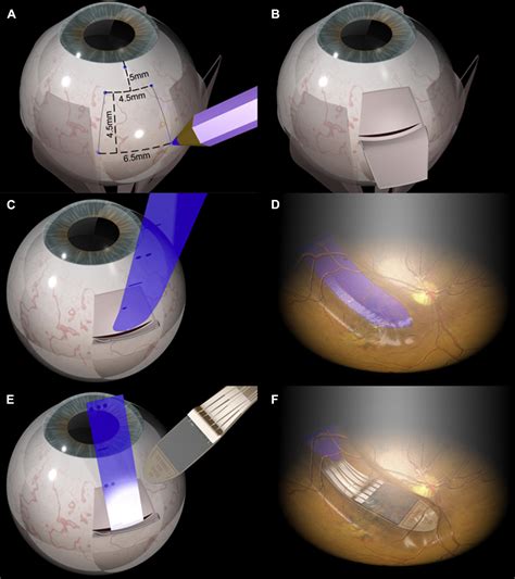 Assessment Of The Electronic Retinal Implant Alpha AMS In Restoring