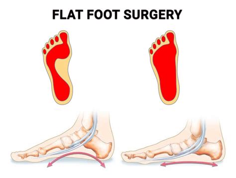Flat Foot Surgery Premier Podiatry Velimir Petkov DPM Podiatrists Clifton NJ