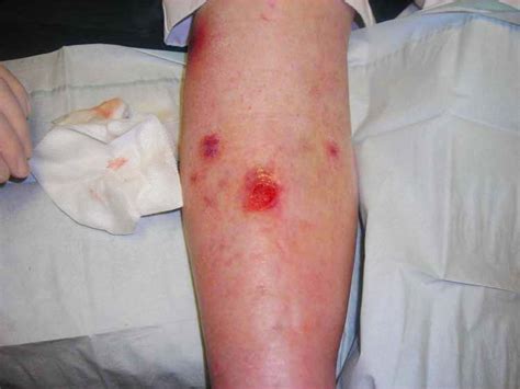 Venous Ulcer Sores How To Treat