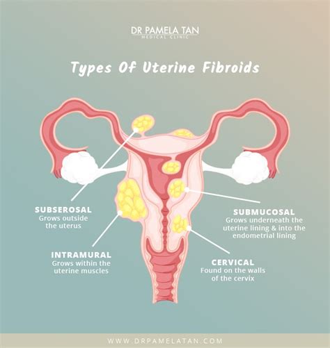 Fibroids Treatments Singapore Dr Pamela Tan Gynaecologist Singapore