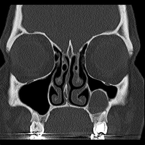 Maxillary Odontogenic Keratocyst Radiology Case