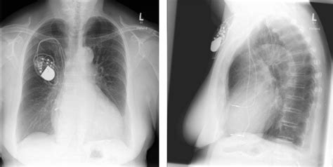 A Three Month Follow Up Chest X Ray B Three Month Follow Up Lateral